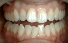 ประเภท สาเหตุ และแนวทางการรักษาโรคฟันผุ ฟันผุ